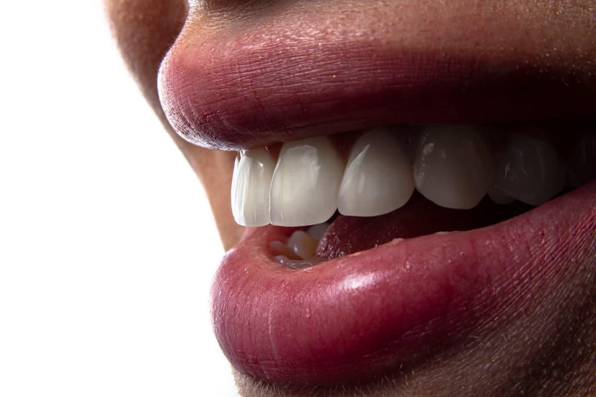 Sorriso depois do clareamento dental